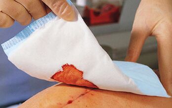 After penis enlargement surgery, it is necessary to apply bandages