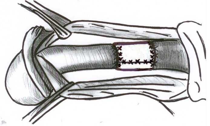 Installation of collagen uterus to increase a member