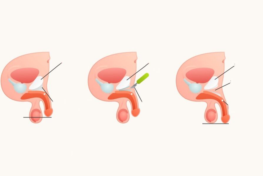 Management to increase penis