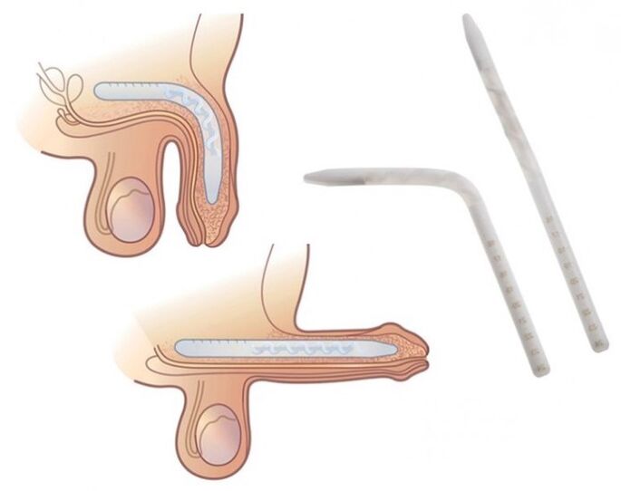 Phalloplasty to increase a member