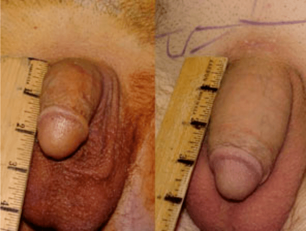 Before and after liposuction and gel implantation