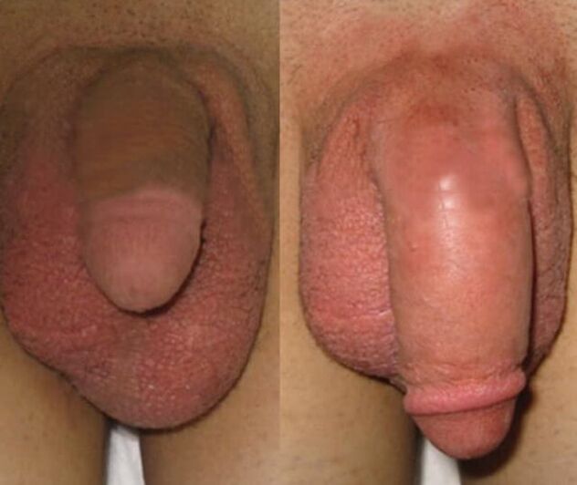 The result of collagen matrix installation on the penis