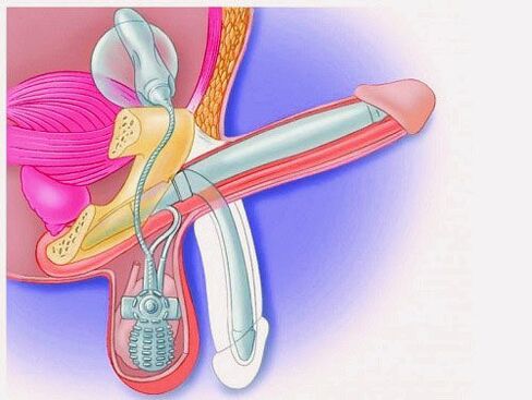 Penis enlargement through a penis prosthesis
